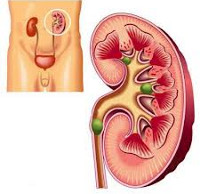 Мочекаменная болезнь Мочекаменная болезнь