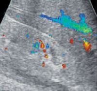 Дуплексное сканирование. ХПН, обеднение внутрипочечного сосудистого рисунка Дуплексное сканирование. ХПН, обеднение внутрипочечного сосудистого рисунка
