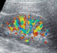 Дуплексное сканирование. Здоровая почка. Нормальный внутрипочечный сосудистый рисунок Дуплексное сканирование. Здоровая почка. Нормальный внутрипочечный сосудистый рисунок