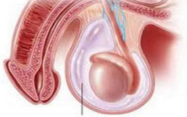hydrocele.jpg