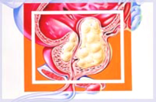 Баллонная дилатация: показания, противопоказания, применение