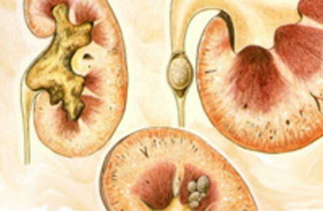 Урология камни в мочеточнике