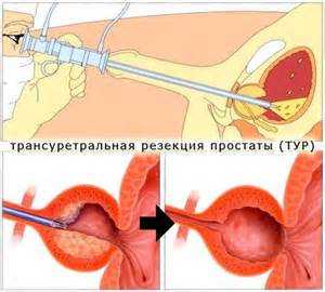 operatsiya_adenoma_prostaty1.jpg