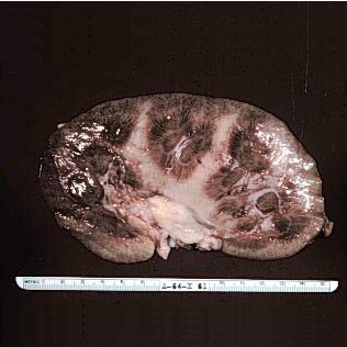 ostrij_glomerulonefrit_661